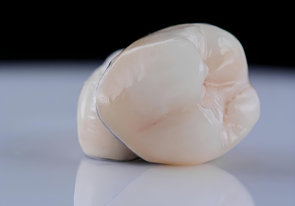 dental crowns kitchener waterloo ontario