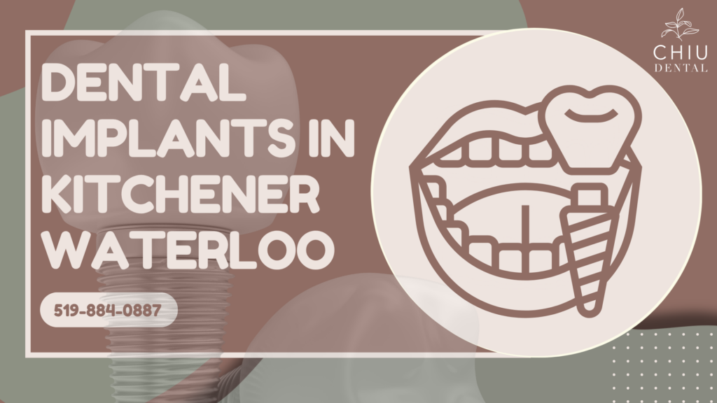 Dental Implants in Kitchener Waterloo